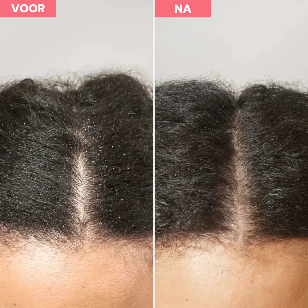 Scalp Detox™ - De kam voor een gezonde hoofdhuid