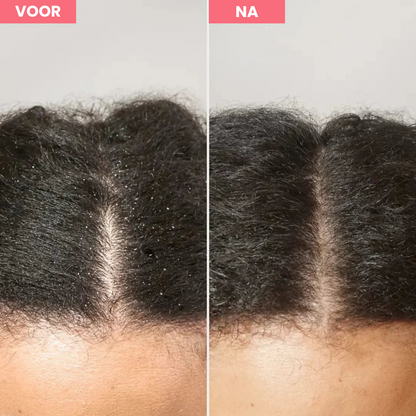 Scalp Detox™ - De kam voor een gezonde hoofdhuid